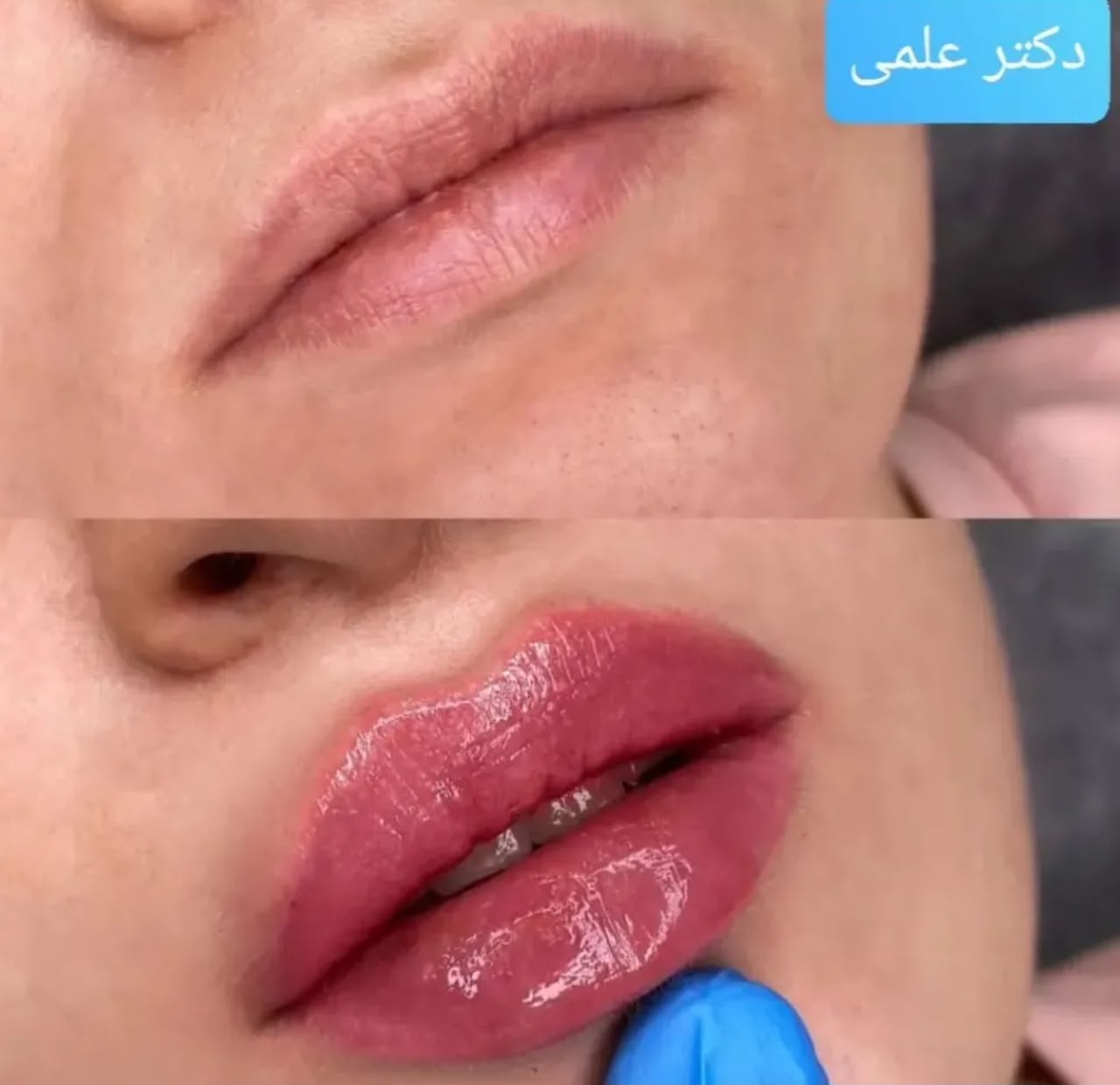 فیلر لب