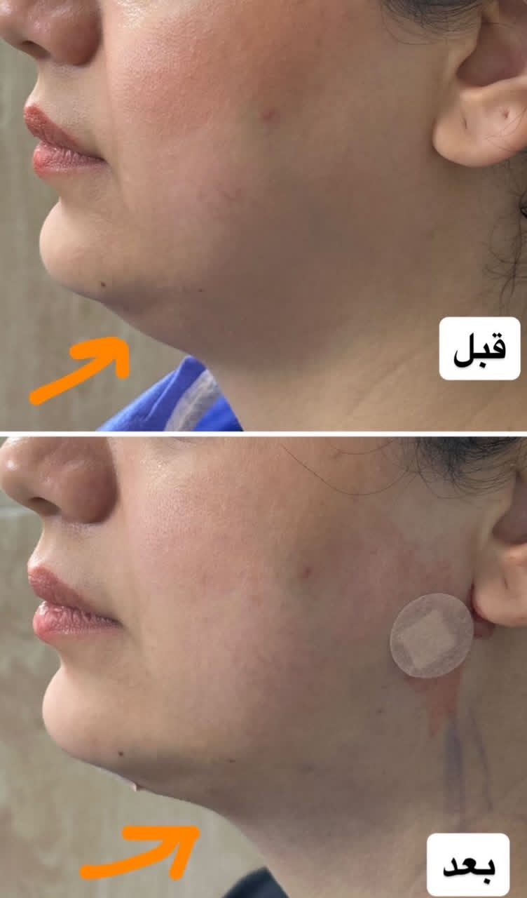 رفع غبغب