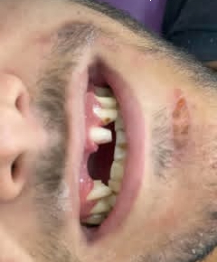 عکس قبل