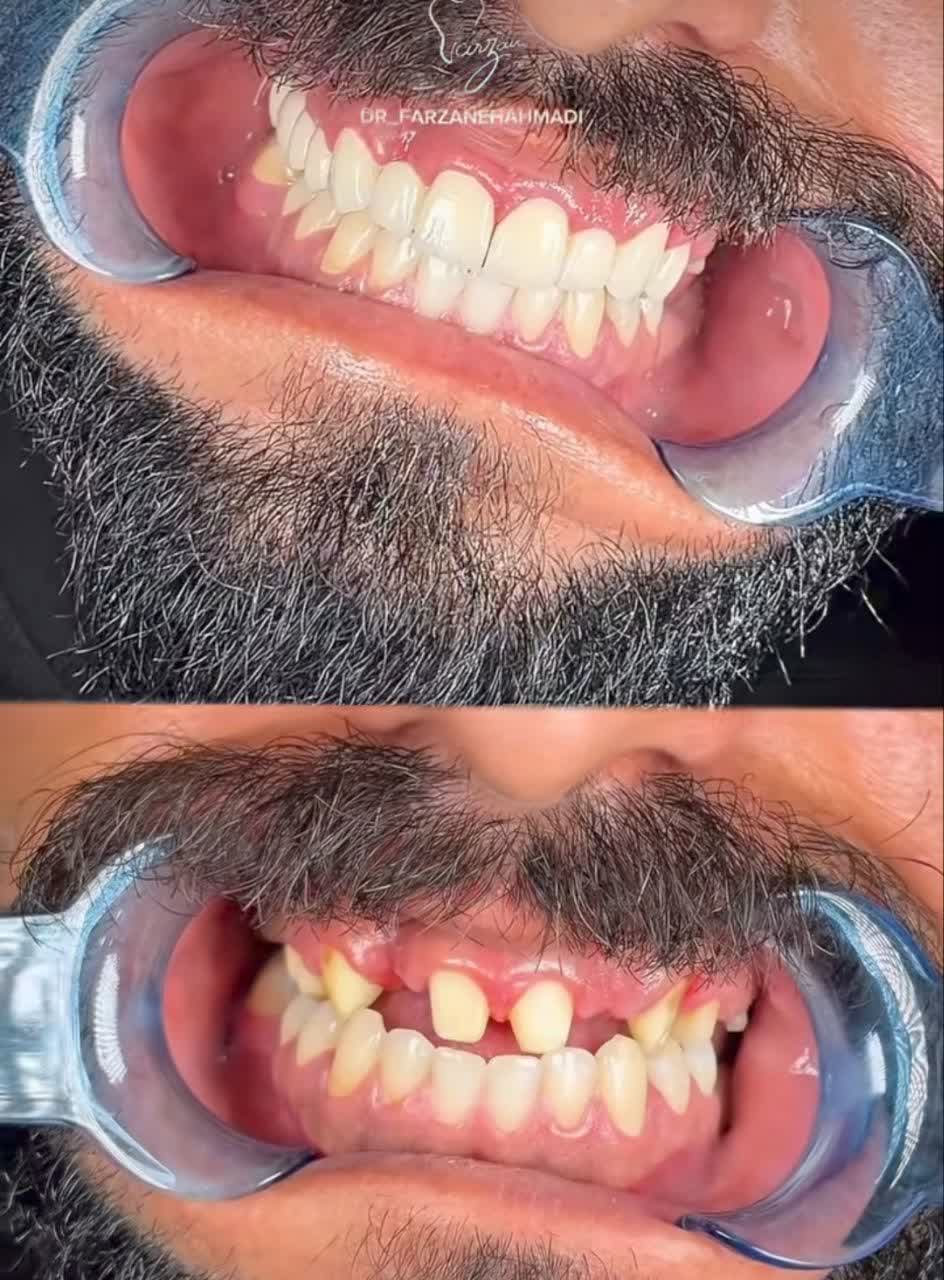 طراحی لبخند