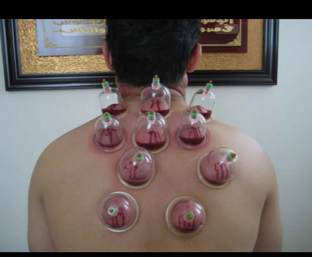 گالری حجامت، ماساژ،زالو درمانی