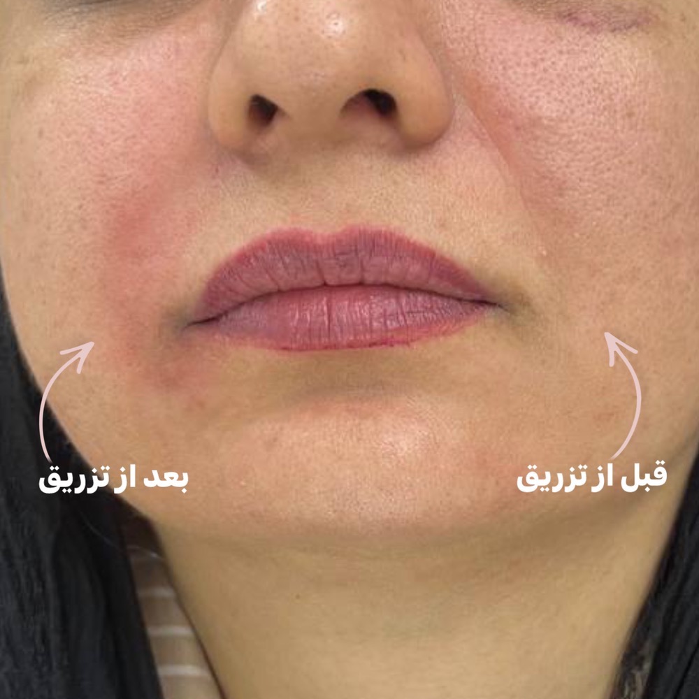 رفع خط خنده