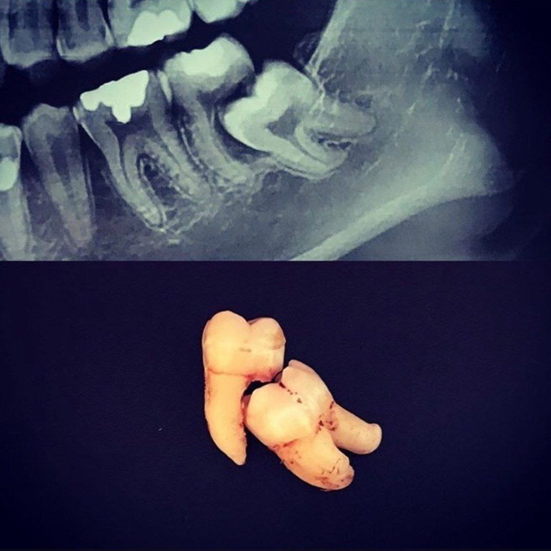 کشیدن دندان قدامی