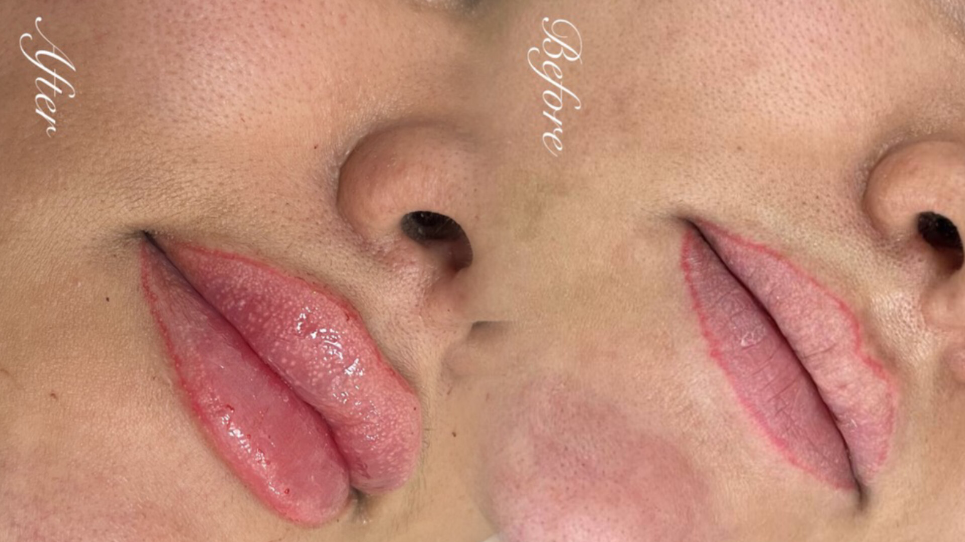 تزریق فیلر لب