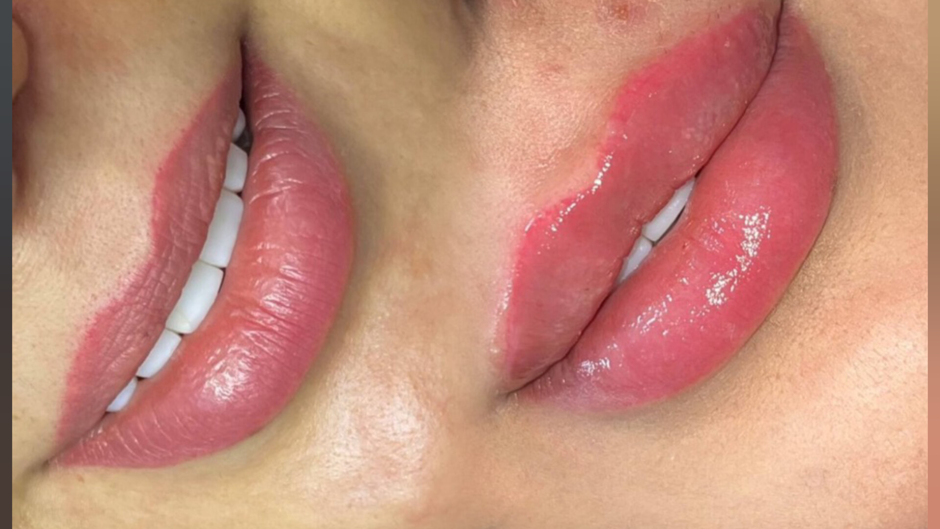 تزریق فیلر لب