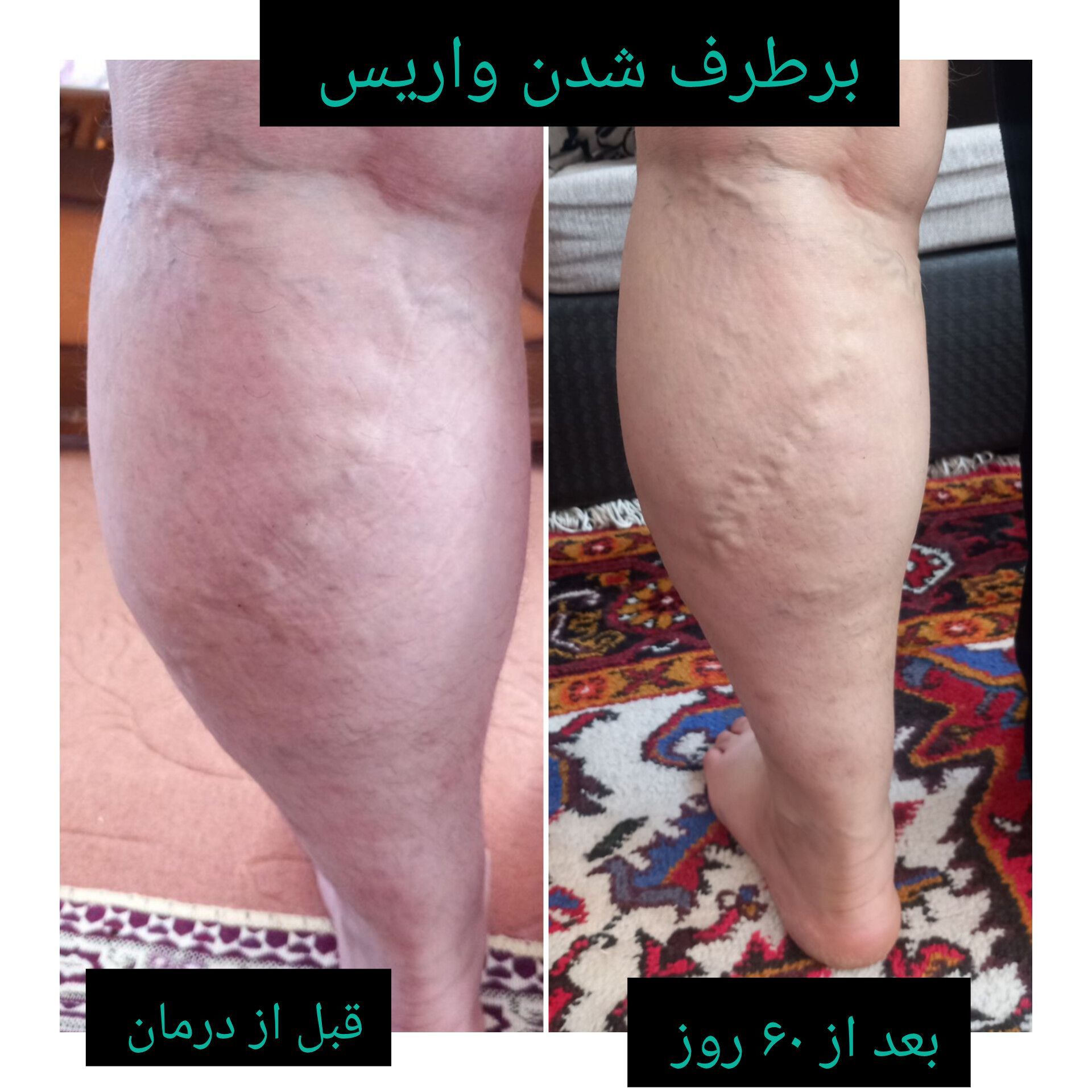 درمان واریس پا 
