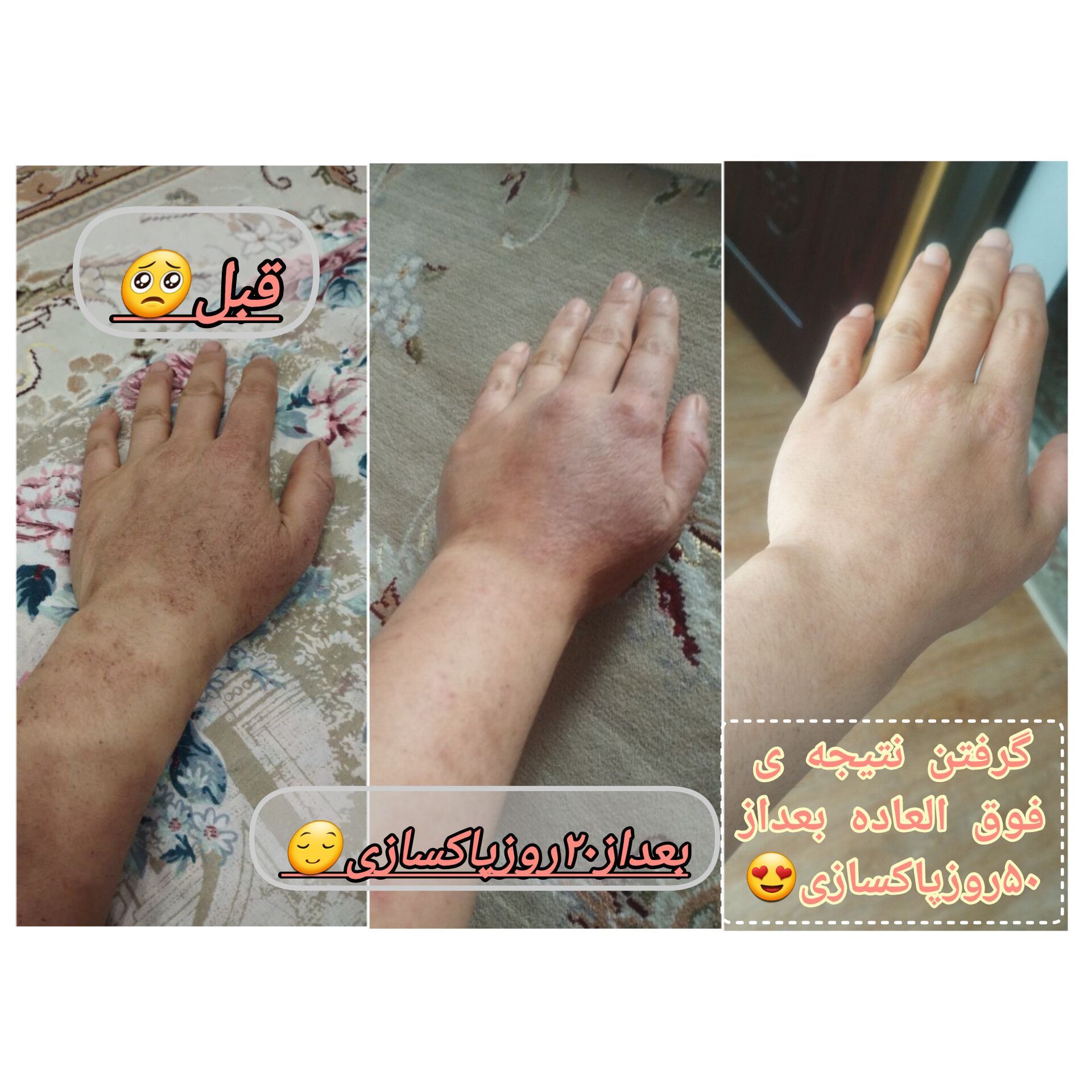 اگزمای پوستی 